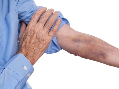 Significant bruising after simple, blood test, apparently fairly common in older people. Unidentified man. Isolated on white.